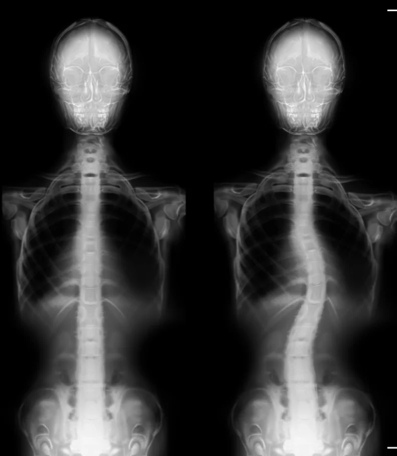 scoliosis Waterloo IA